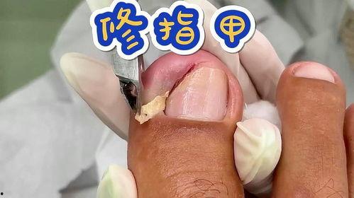 修脚指甲视频,轻松掌握专业修脚技巧