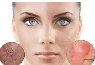 痘坑填平视频,揭秘高效美肤秘诀