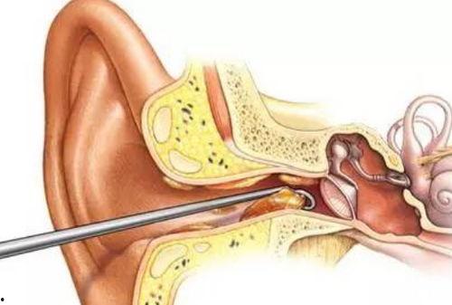 耳屎是怎么形成的视频